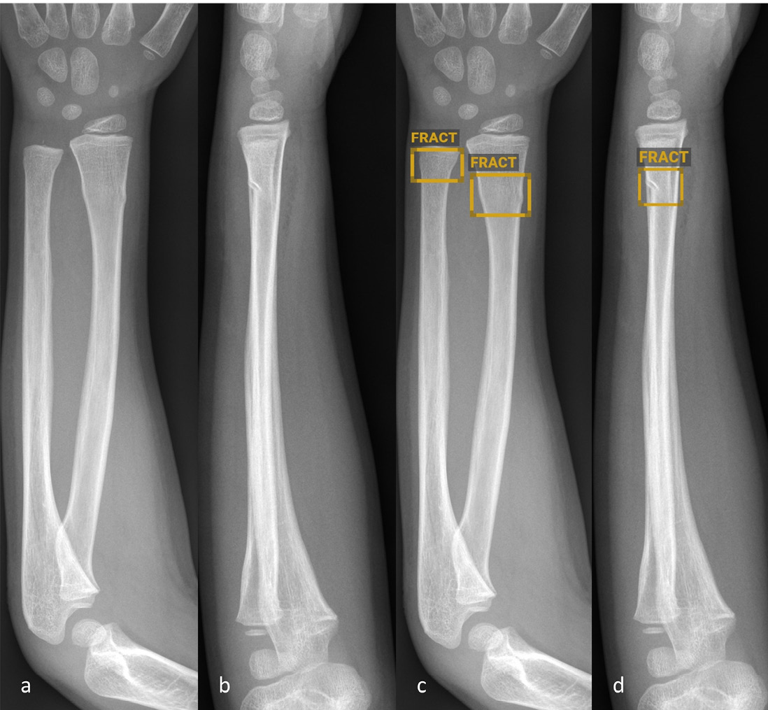 fracture en tore métaphysaire distale identifiée par l'IA
