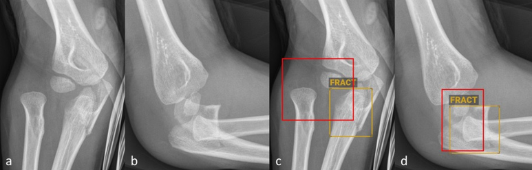 Radiographies antéro-postérieures (a et c) et latérales (b et d) de l’avant-bras d’un enfant âgé de six ans sans (a–b) et avec (c–d) marquage diagnostique réalisé par BoneView. 